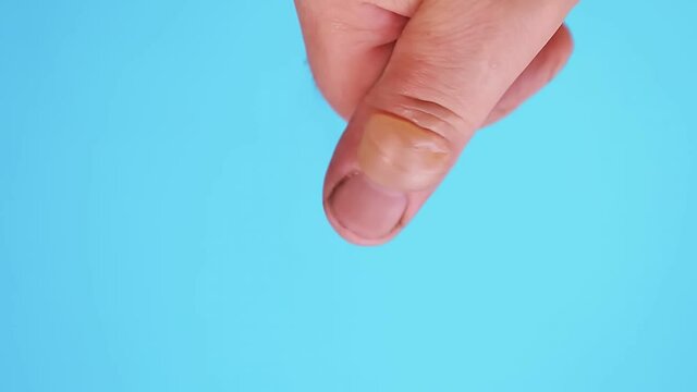 A large blister from a burn on the finger of a man s hand on a blue background