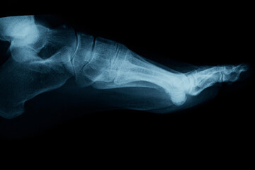 X-Ray of an human foot