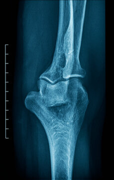 X-ray of an human elbow
