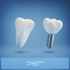 Vector with realistic dental implant and healthy tooth on a blue background. 3d. Element for design, layout template for dental clinics