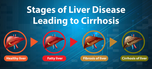 Naklejka premium Stages of liver disease leading to Cirrhosis