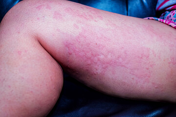 Skin disease on the body, viral skin disease Measles rash with dermatitis of Itching blister dermatitis Urticaria on body Health problem allergy symptoms Redness and peeling of the skin on the leg.