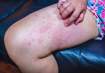 Skin disease on the body, viral skin disease Measles rash with dermatitis of Itching blister dermatitis Urticaria on body Health problem allergy symptoms Redness and peeling of the skin on the leg.