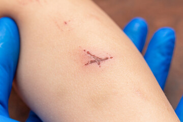 wounds, scratches, abrasions on the child’s leg, knee close up