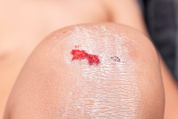 wounds, scratches, abrasions on the child’s leg, knee close up