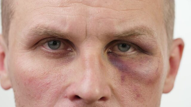Bruise on the eye of a man