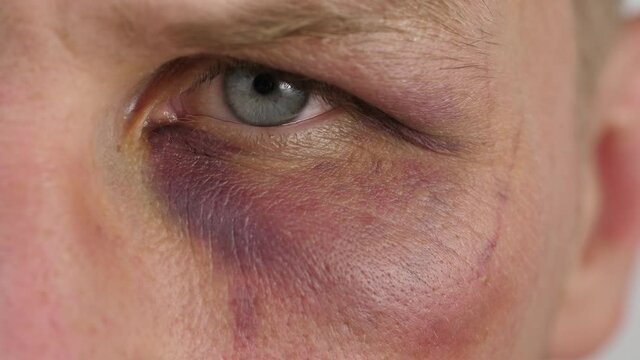 Bruise under the eye of a man
