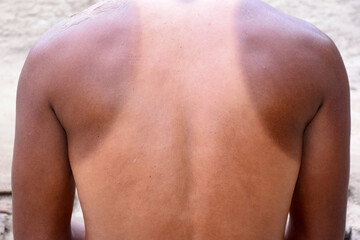 Fototapeta premium Extra sun-scorched shoulders and neck skin, The body part between the lateral upper joint of the human arm and the neck, reaction to injury or infection