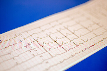 Cardiology Paper Graph on Blue Background