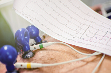 Cardiology Tools Being PlanCardiology Tools on a Man's Chest with a Paper Graphted on a Man's Chest by a Doctor