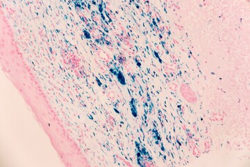 Skin with heavy iron deposits, called hemosiderin, which appear blue in this special stain. The...