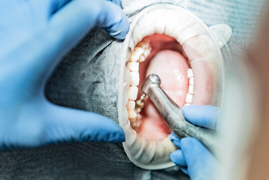 Open Mouth through optragate. Dentist office. Dentist making professional teeth cleaning male young patient at the dental office. Close-up plan