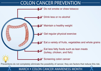 Colon cancer prevention infographic vector. March colon cancer awareness month concept. Well-organized Eps 10 file.