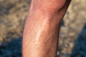 scar on the leg, after injury. The last stage of wound healing, scarring. Skin trauma, wound change...