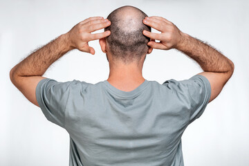 A man holds his hands over his bald head, demonstrating focal alopecia. Rear view. The concept of...