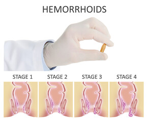 Doctor holding suppository for hemorrhoid treatment over illustration of lower rectum progressing...
