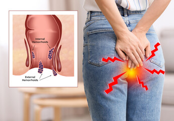 Young woman suffering from hemorrhoid pain at home, closeup. Illustration of unhealthy lower rectum - obrazy, fototapety, plakaty