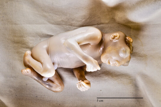 17 week old male human fetus with anencephaly, right side view.