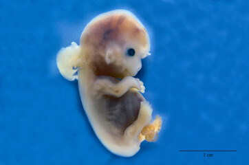 Human embryo with occipital encephalocele.