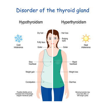 Hyperthyroidism and Hypothyroidism. Female with Signs and symptoms of different thyroid gland diseases