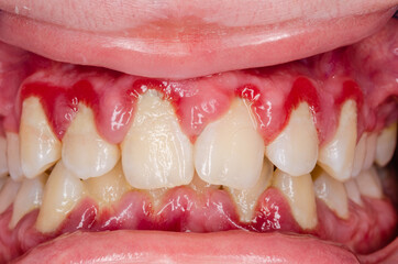 close up of teeth, dental plaque and gingivitis - obrazy, fototapety, plakaty