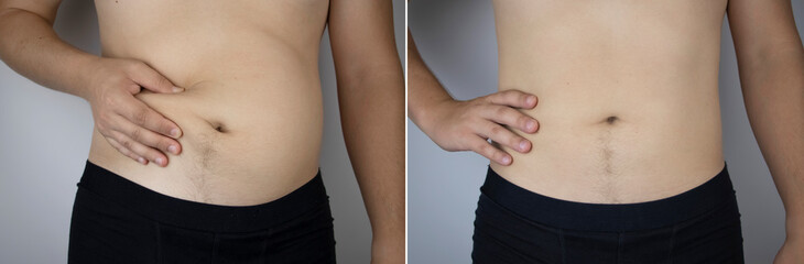 The man shows the results of work on the body. Before and after a thick and thin waist. In the photo on the left, belly fat is visible. In the photo on the right, a thin waist without extra kilograms