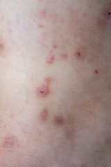 Fototapeta premium Itchy rash on the skin