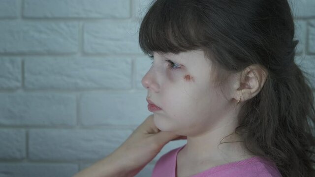 Have pity on the child. A mother strokes her little daughter with wounds on her face on the shoulder.