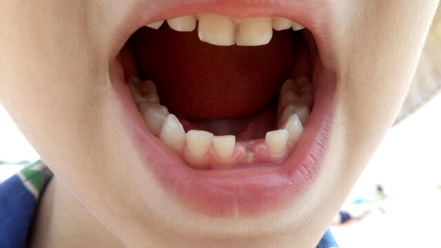 The first milk tooth fell out. Teeth in the mouth of a child.