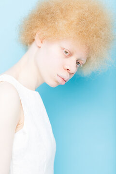 Portrait of albino young woman