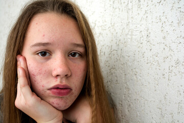 A teenage girl has acne on her face, problem skin. Acne on the face of a teenager. Acne on the face.