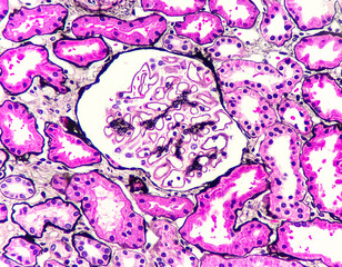 Obraz premium Photo of membranous nephropathy. This glomerulus reveals subepithelial deposit, photo under microscope, silver stain, magnification 400x