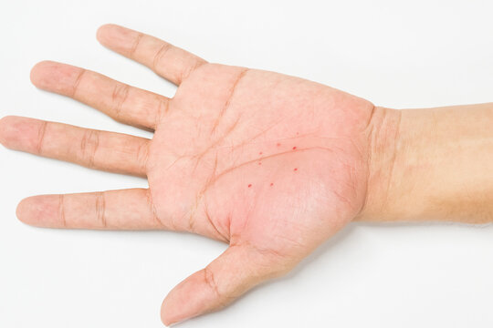 Atopic dermatitis (AD) on the hand, also known as atopic eczema or dyshidrotic eczema. Allergy on skin.