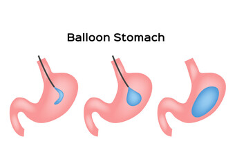 balloon stomach vector . human anatomy