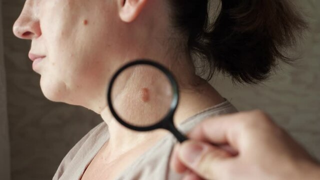 Dermatologist examines a mole on the patient's neck using a magnifying glass.