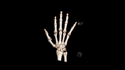Computed Tomography Volume Rendering examination of the hand showing normal anatomy ( CT VR hand). 3D rendering