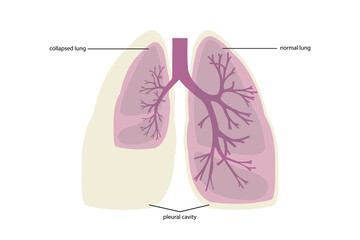 lung deflation, pneumothorax