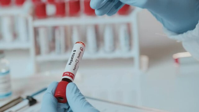 Doctor holds in one hand laboratory holds blood sample positive with hepatitis B virus label, other handwriting down results to patients medical record. Laboratory medical diagnostics
