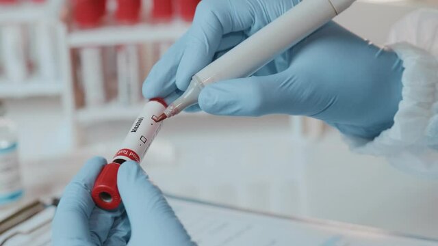Doctor or laboratory technician holds in one hand laboratory positive blood sample for an alcohol test, other handwriting down results to patients medical records. Laboratory medical diagnostics