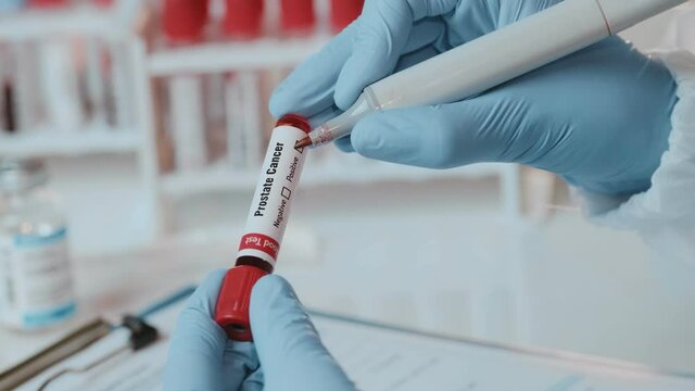 Doctor or laboratory technician holds in one hand laboratory positive blood test tube for cancer prostate, other hand writing down results to patients medical record. Laboratory medical diagnostics
