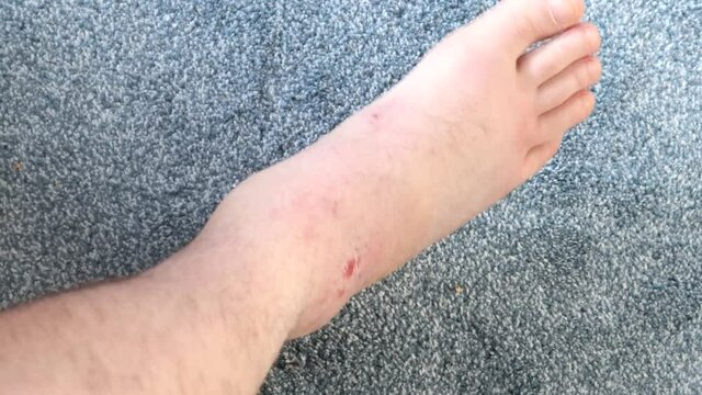 A Swollen Damaged Ankle With Ligament Damage 