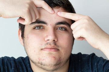 Portrait of young man looking for acnes on his face
