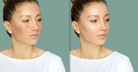 Dark spots, freckles,hyperpigmentation(melasma or chloasma),concept- skin lightening, skin whitening, Skin Brightening	