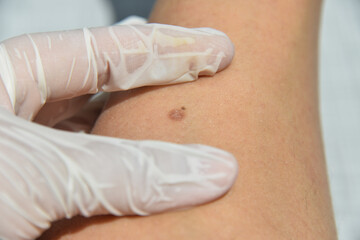 Skin diseases irritation, itching, cracked wounds lead to painful sensations. The skin may grow papillomas, warts, moles, white and dark spots will appear.