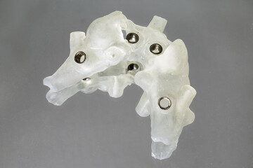 special surgical template for implantation of four implants