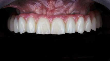 ceramic prosthesis made of high quality materials, installed on the patient's upper jaw © Dental Pro Content