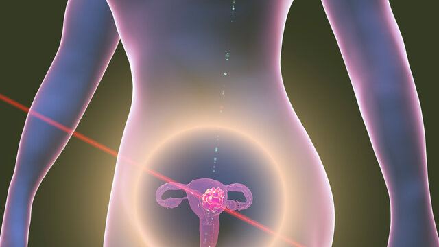 Uterine cancer, illustration