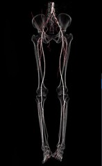 CT SCAN 3D of vascular of both with transparent bone. CTA Peripheral run-off