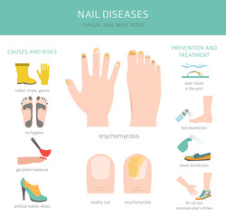 Nail diseases. Onychomycosis, nail fungal infection causes, treatment icon set. Medical infographic design