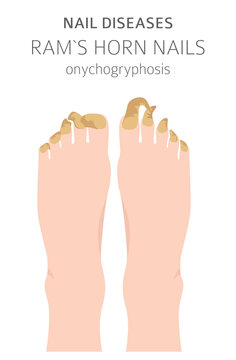Nail diseases. Onychogryphosis, Ram`s horn nail. Medical infographic design